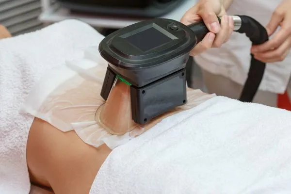 Image of person having fat freezing treatment to help weight gain Newton Mearns