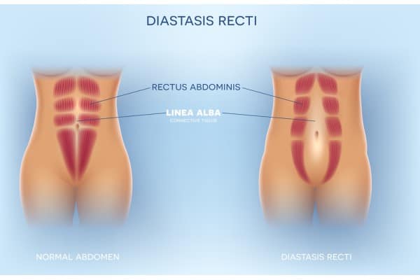 What Non-Surgical Options Are Available for Diastasis Recti Newton Mearns?