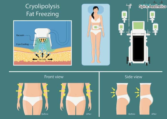 Image of diet and fat freezing combined for best results for Spire Aesthetics Newton Mearns