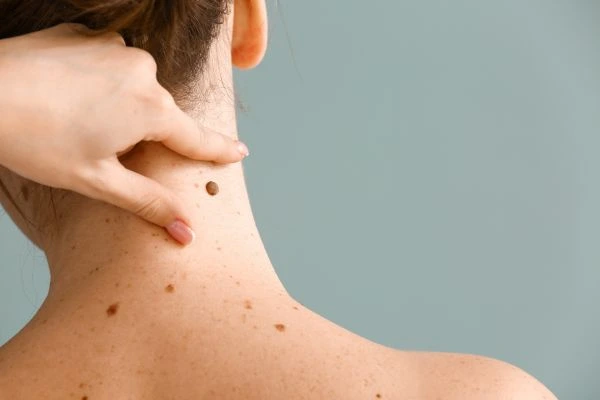 skin blemish removal Newton Mearns treatment