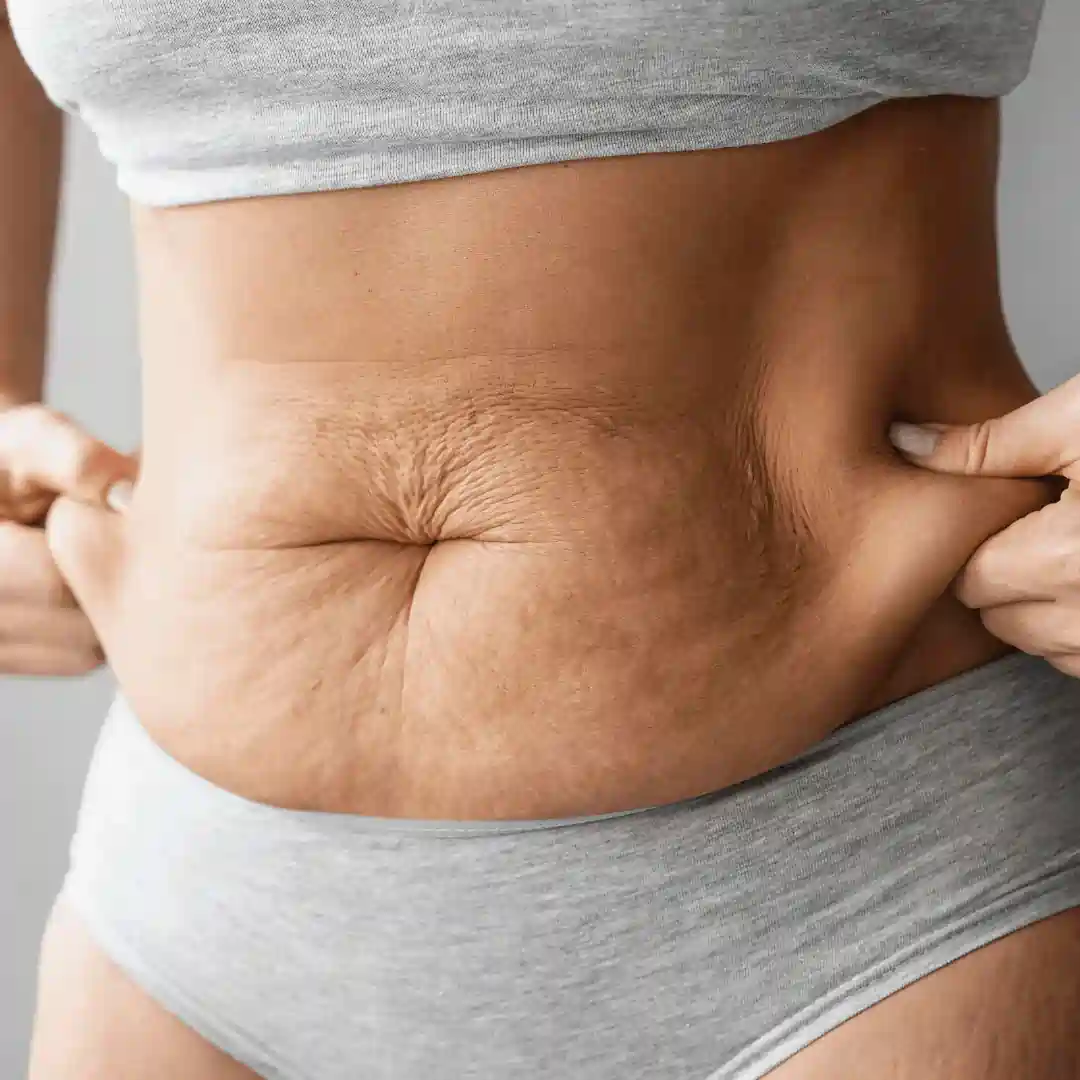 Is It Normal to Have Loose Skin After Pregnancy Newton Mearns?